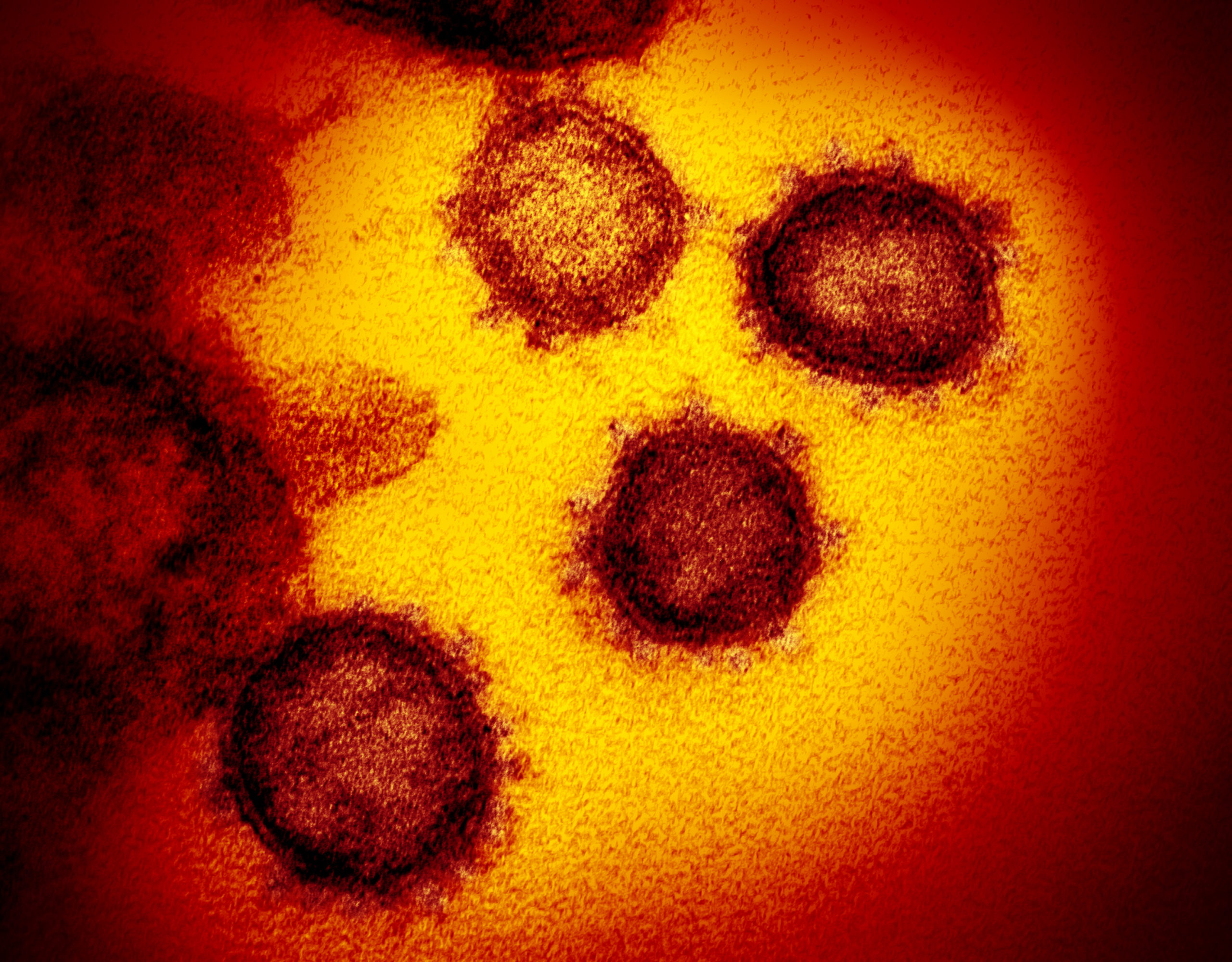 Electron microscope image of novel coronavirus SARS-CoV-2